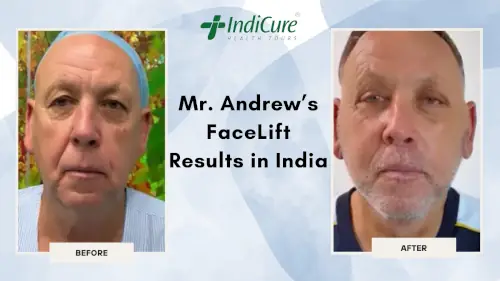 Mr. Andrew's Facelift Results in India Mr. Andrew's Facelift Results in India